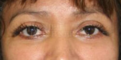 Eyelid Surgery