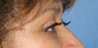 Eyelid Surgery