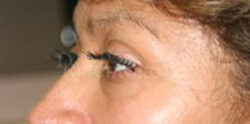 Eyelid Surgery