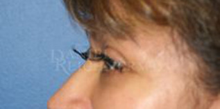 Eyelid Surgery