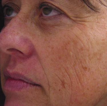 Skin Rejuvenation