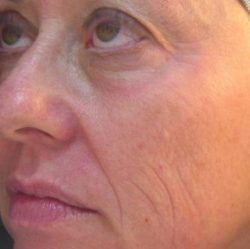 Skin Rejuvenation