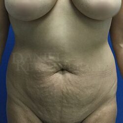 Abdominoplasty (Tummy Tuck)