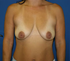 Breast Reduction