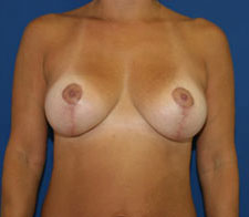 Breast Reduction