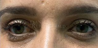 Eyelid Surgery