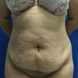 Abdominoplasty