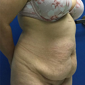 Abdominoplasty (Tummy Tuck)