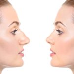Young woman with nasal hump before and after rhinoplasty