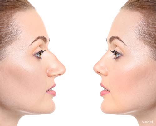 Young woman with nasal hump before and after rhinoplasty