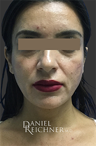 Facial Fat Grafting: Before & After Photos
