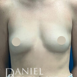 Breast Augmentation