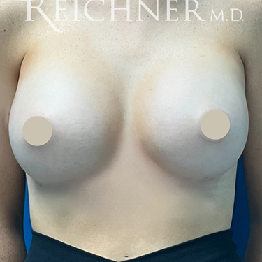 Breast Augmentation