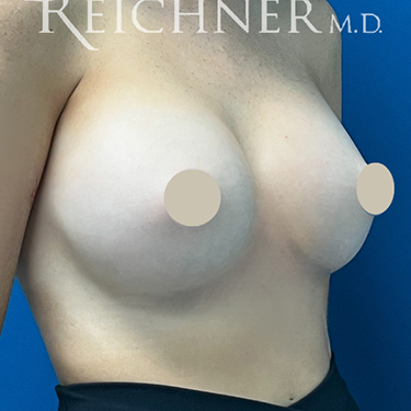 Breast Augmentation