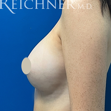 Breast Augmentation