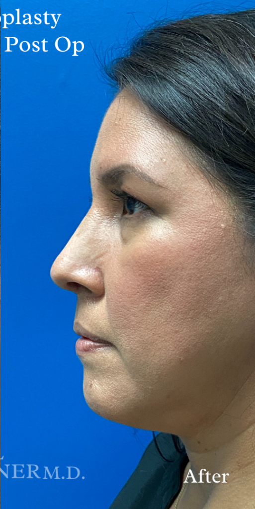 Rhinoplasty