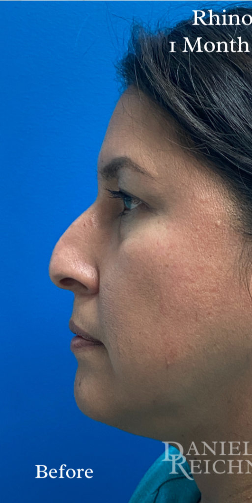 Rhinoplasty