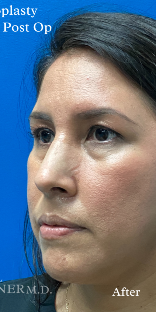 Rhinoplasty