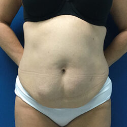 Abdominoplasty (Tummy Tuck)