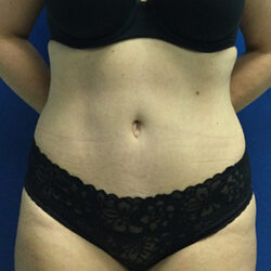 Abdominoplasty (Tummy Tuck)