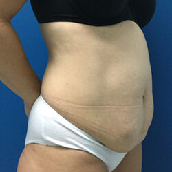 Abdominoplasty (Tummy Tuck)