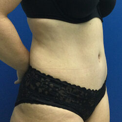 Abdominoplasty (Tummy Tuck)