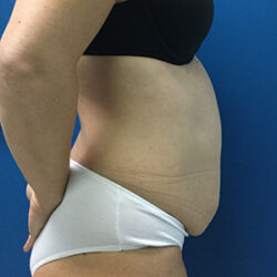 Abdominoplasty (Tummy Tuck)