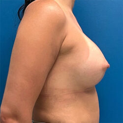 Breast Augmentation