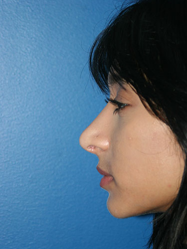 Rhinoplasty