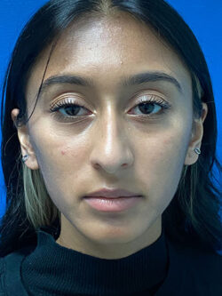 Rhinoplasty