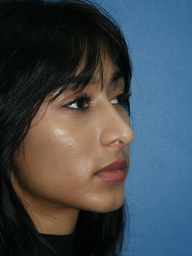 Rhinoplasty