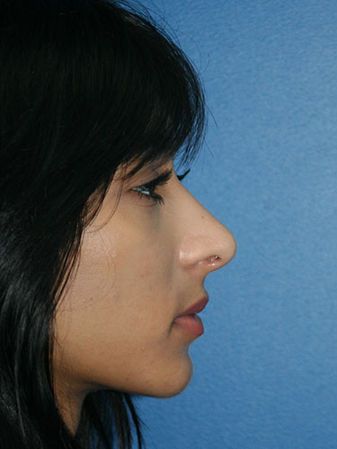 Rhinoplasty