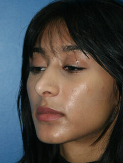 Rhinoplasty