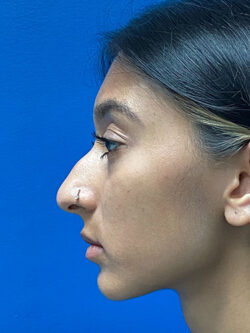 Rhinoplasty