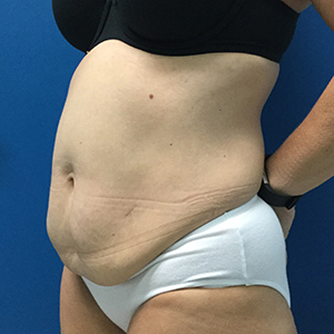 Abdominoplasty (Tummy Tuck)