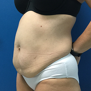 Abdominoplasty (Tummy Tuck)