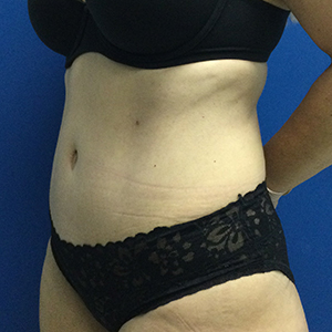 Abdominoplasty (Tummy Tuck)