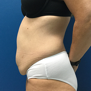 Abdominoplasty (Tummy Tuck)