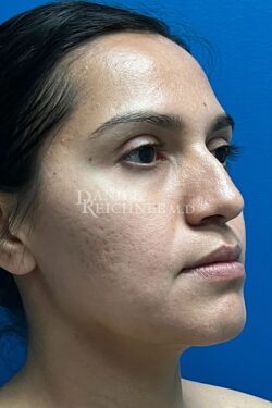 Rhinoplasty