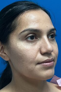 Rhinoplasty