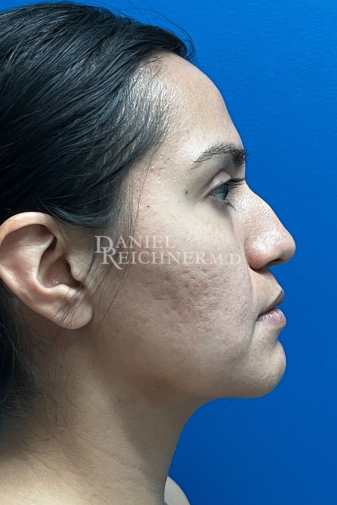 Rhinoplasty