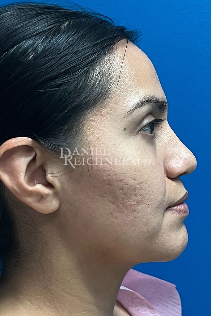 Rhinoplasty