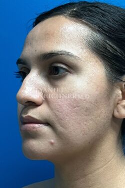 Rhinoplasty