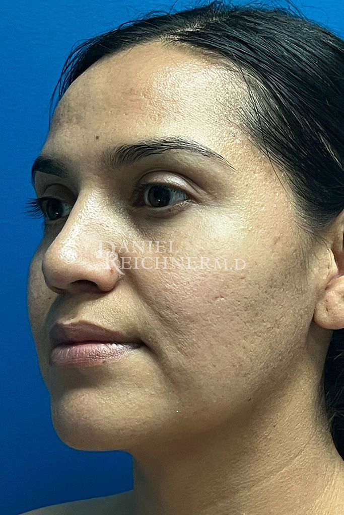 Rhinoplasty