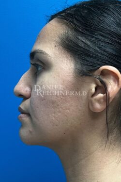 Rhinoplasty