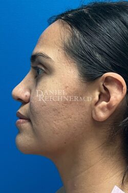 Rhinoplasty