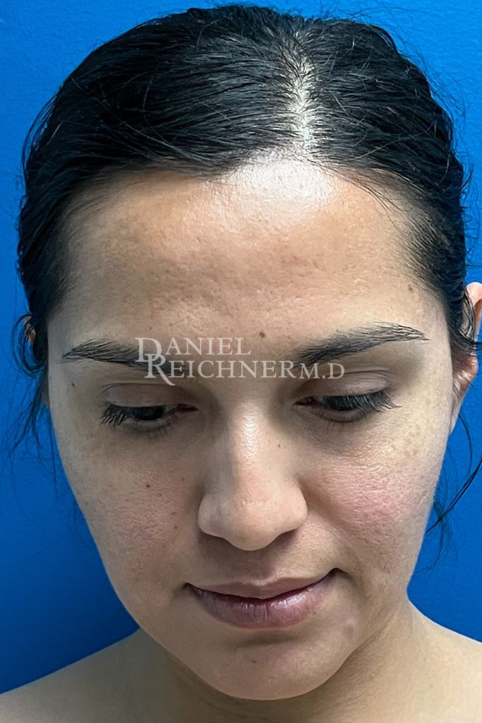 Rhinoplasty