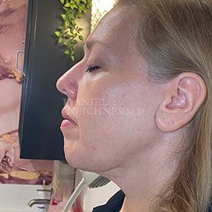 Facelift / Necklift