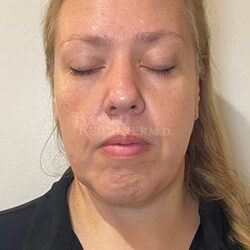 Facelift / Necklift