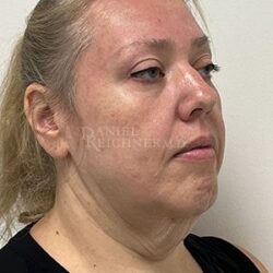 Facelift / Necklift